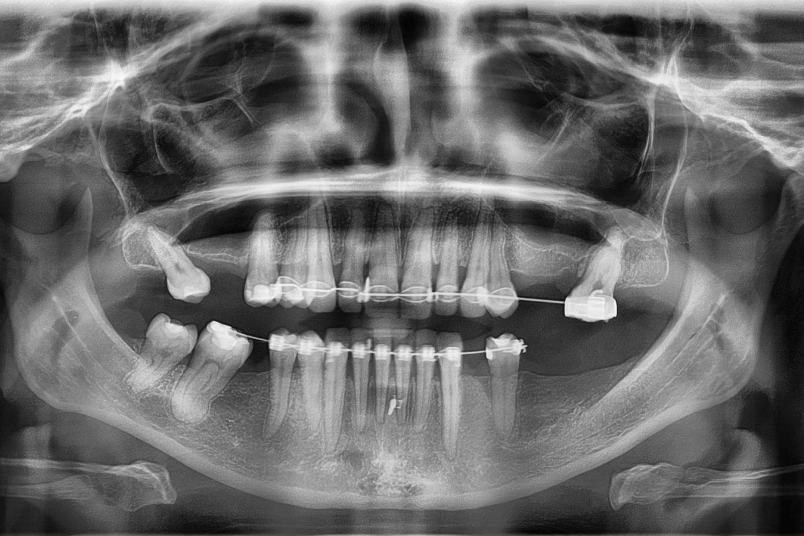 zdjęcie rtg zębów z aparatem ortodontycznym